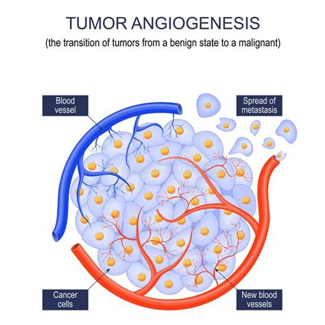 Tumor angiogenesis stock vector. Illustration of blood - 261898775