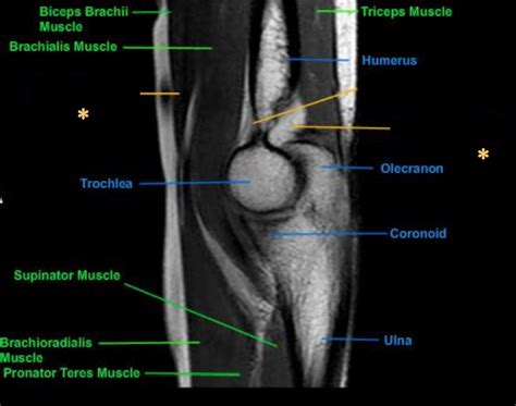 Elbow Sagittal Mri Diagram Quizlet