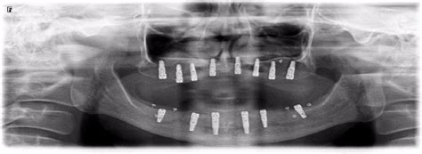 Postoperative panoramic radiography after dental implant operation ...