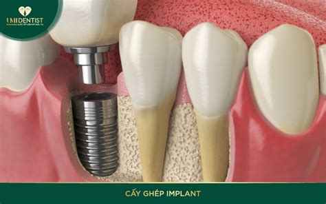 Cấy ghép Implant có đau không Nha Khoa Umi Dentist