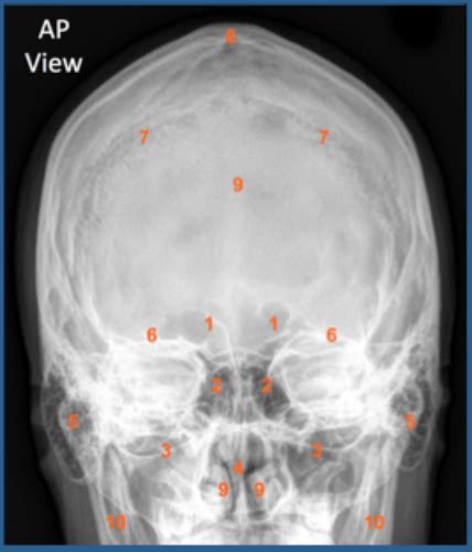 Nerv Dsa Brain Imaging Flashcards Quizlet