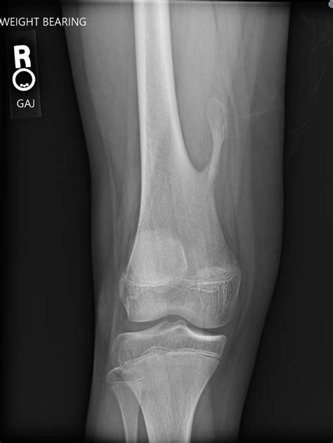 Fractured Osteochondroma Radiology Case Radshare Net