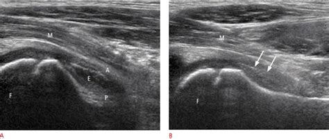 Ultrasonography Of The Pediatric Hip And Spine Pmc