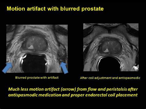 Multi-parametric MRI (MP-MRI) in prostate- Experience and Technical ...