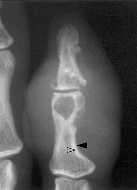 X Ray Film Showing Multiple Intraosseous Radiolucencies Located In The