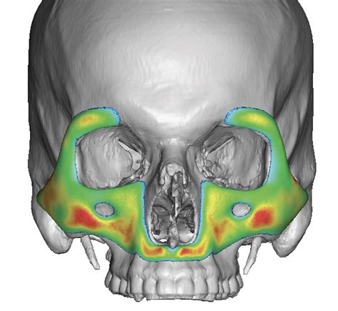 Custom Midface Implant Thicknesses Dr Barry Eppley Explore Plastic