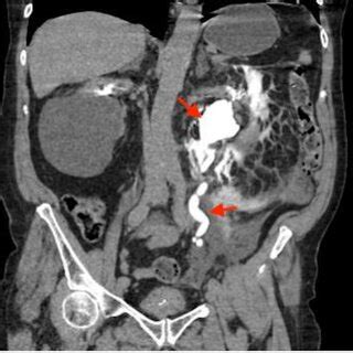 CT Urogram—Coronal section; delayed phase image demonstrating contrast ...