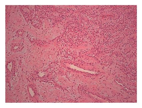 Hematoxylin And Eosin Hande Stain On Low Power ×20 A Magnification