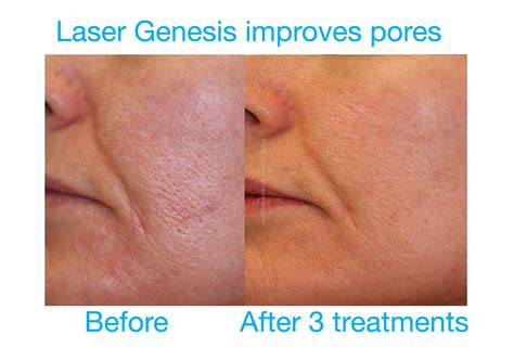 Laser Genesis Treatment - No Downtime, Skin Polishing