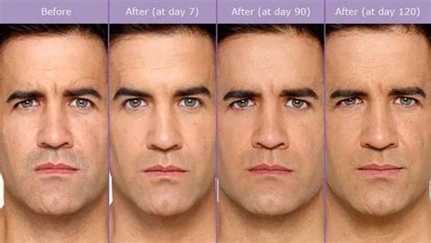 Botox Illume Cosmetic Surgery Medspa