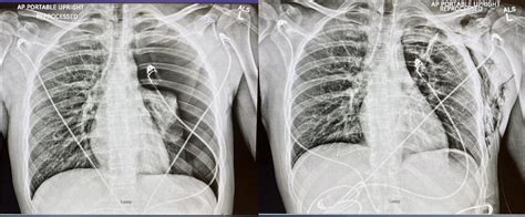 Left Sided Pneumothorax on Chest X-ray Before and after Chest Tube ...