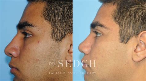 Crooked Nose Surgery Before After Photos Dr Sedgh