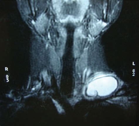 Figure From Primary Hydatid Cyst An Unusual Cause Of A Mass In The