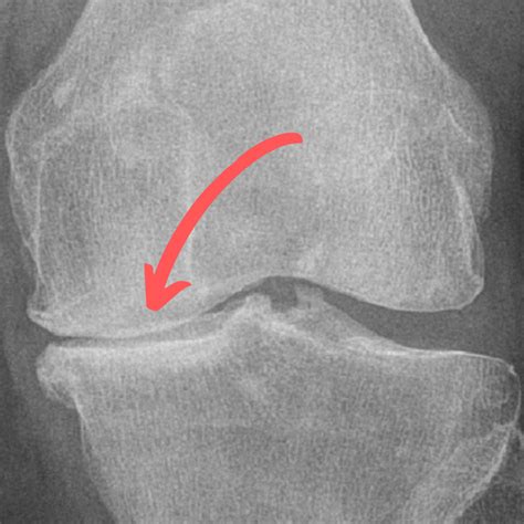 Arthritis In Knee X Ray