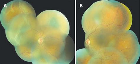 Scielo Brasil Case Report Pneumatic Retinopexy For The Treatment Of