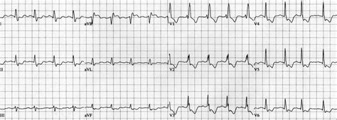 Lmca Occlusion St Elevation In Avr • Litfl • Ecg Library Diagnosis