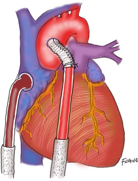 Standard Aortic And Atrial Cannulation For Longterm Ecmo Support