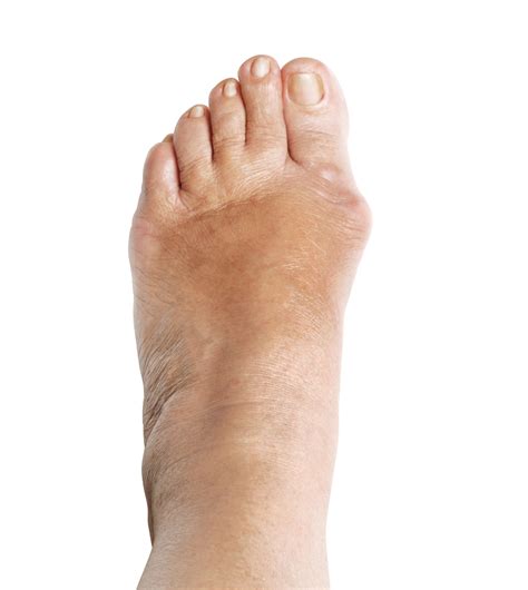 Manhattan Bunion Hammertoe Surgeons Pain Relief Treatment The