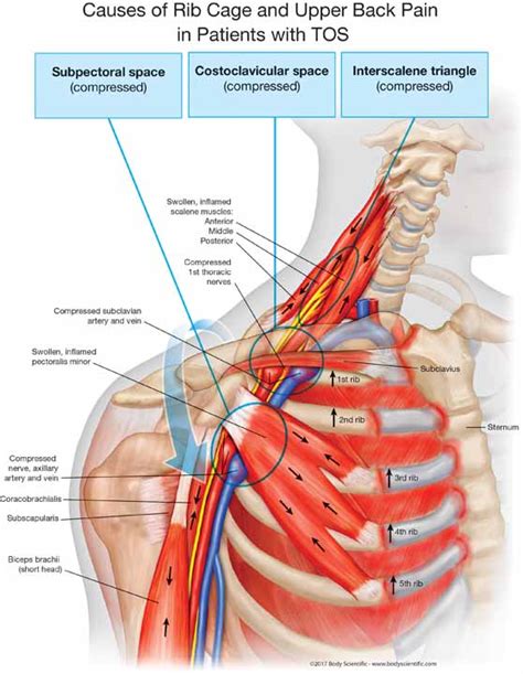 Chapter 1 Thoracic Outlet Syndrome