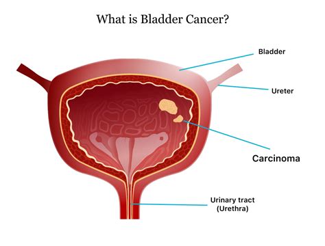 What Does Squamous Cell Cancer Of The Vulva Look Like