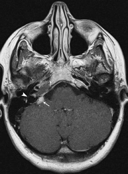 Jugular Foramen Mri