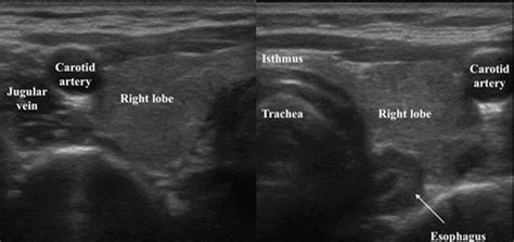 Thyroid Ultrasound Anatomy