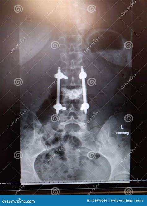 Titanium stock photo. Image of back, rods, exray, xraypain - 159976094