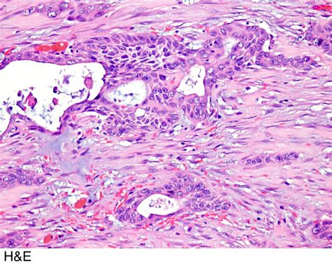 Pathology Outlines Adenosquamous Carcinoma