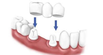 Dental Cement For Crowns Oral Health