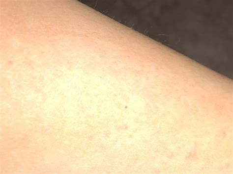 Weird Rash All Over Boob Pic Alert Glow Community