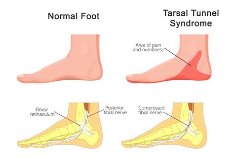 Tarsal Tunnel Syndrome Treatment in Fairfax, VA and Potomac, MD | SAPNA ...