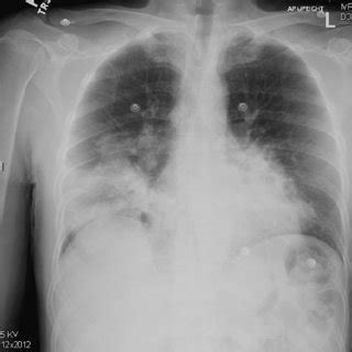 Portable Anteroposterior Chest Radiographs Showing A Initial