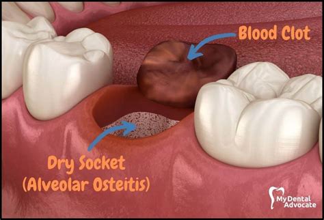 Worst Day Of Pain After Wisdom Tooth Extraction TheDentech