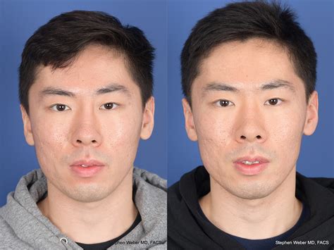 Revision Rhinoplasty Before And After Weber Facial Plastic Surgery