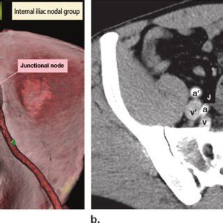 External iliac lymph node group. Illustration (a) and axial ...