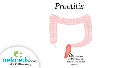 Proctitis Symptoms Causes And Treatment | The Best Porn Website