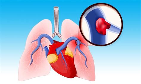 Sex Matters In Treatment Outcomes For Pulmonary Embolism Worlds