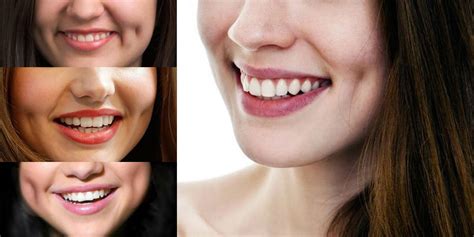 Dimples, a Symbol of Beauty or an Abnormality?