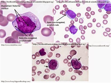 Haematology in a NutShell: Myeloblastic Auer Rods