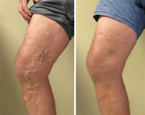 Sclerotherapy Procedure Recovery Aftercare Side Effects