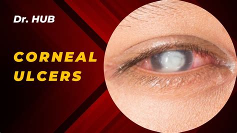 Types Of Corneal Ulcers Youtube