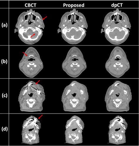 Figure 5 From CBCT Based Synthetic CT Image Generation Using