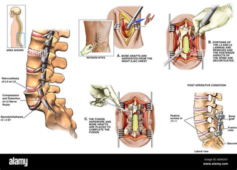 Lumbar Laminectomy Surgery High Resolution Stock Photography And Images