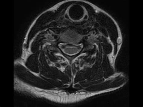 Cervical Spine With Acoustic Noise Reduction Philips Mr Body Map