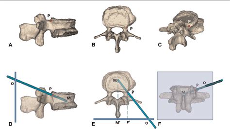 Table 1 From A Modified Trajectory Of Kyphoplasty Via Superior Pedicle Notch For Osteoporotic