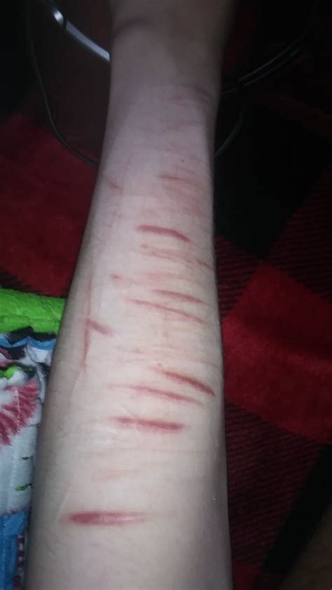 Old SH scars : r/scars