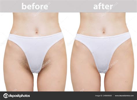 Apropiado Dime Dividir Depilacion Laser Bikini Antes Y Despues A La