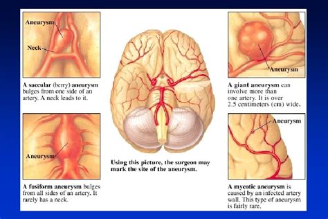 Enfermedades Vasculares Cerebrales Tema Hemorragia Cerebral Definicin