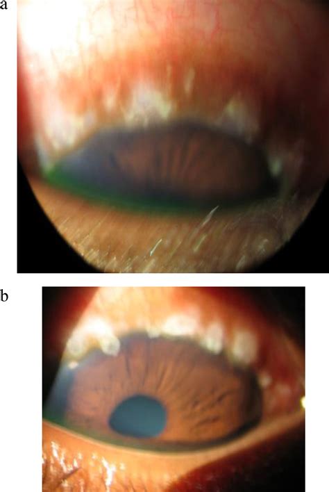 Ocular Surface Disease A Case Of Vernal Keratoconjunctivitis Contact Lens And Anterior Eye