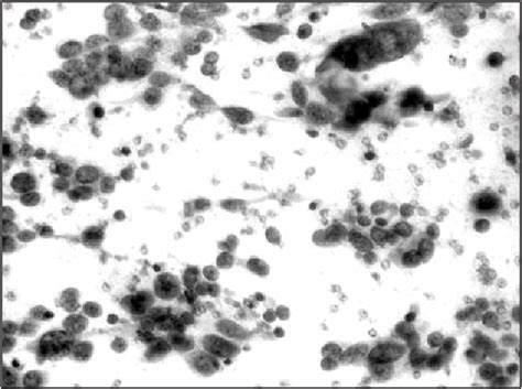 Figure 3 From Critical Role Of Fine Needle Aspiration Cytology And